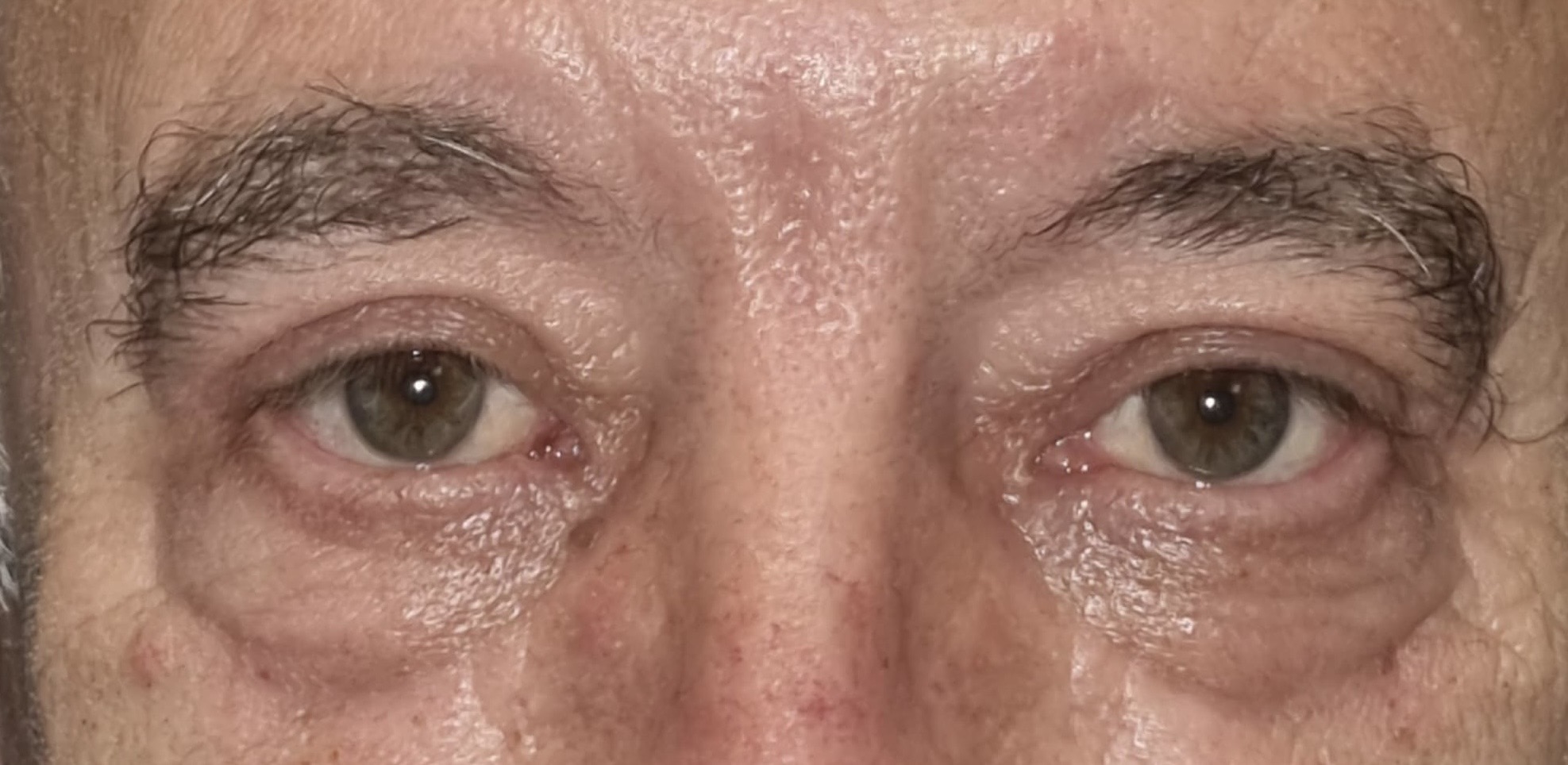 Resultado cirugía oculoplástica Bilbao — caso 4 después