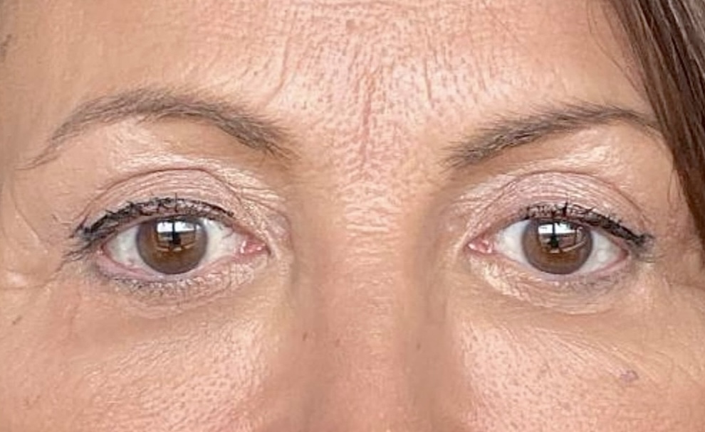 Resultado xantelasmas o malposición palpebral Bilbao — caso 5 después
